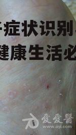 水痘子症状识别与防治策略-健康生活必备知识