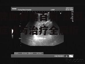 四、脾血管瘤的治疗