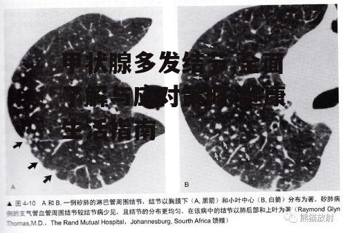 三、甲状腺多发结节的诊断方法